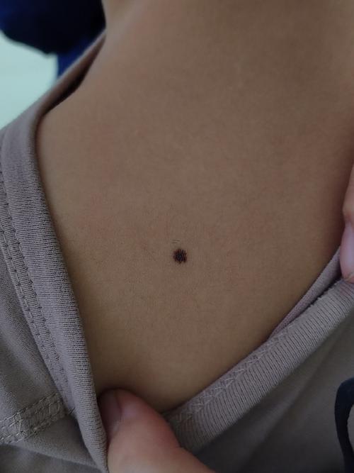 后背有痣