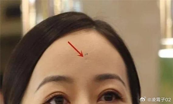 天庭凹陷