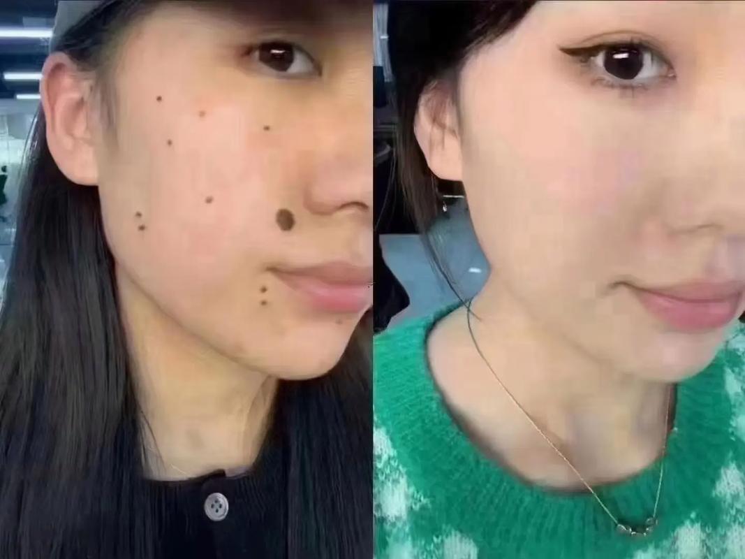 右臉頰有痣