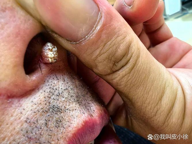 鼻頭長(zhǎng)痣
