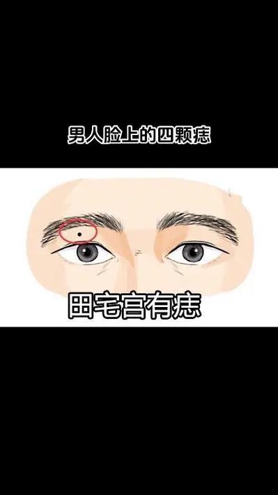 顴骨有痣
