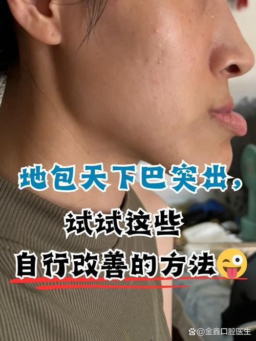 下頜骨突出