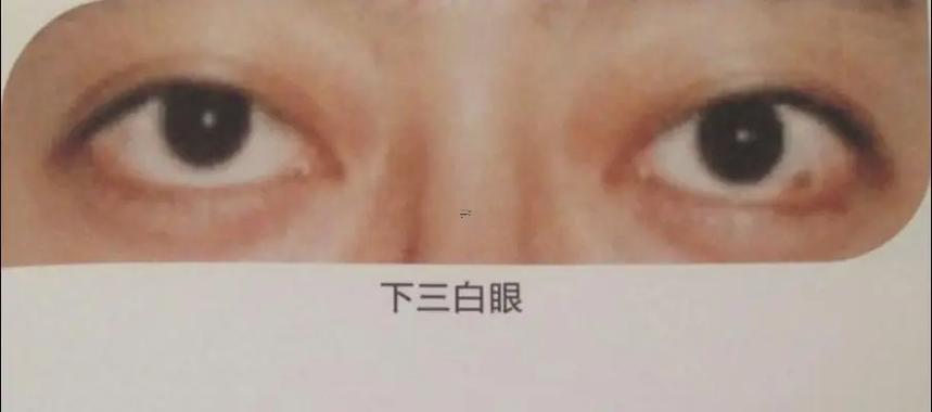 何事是三白眼
