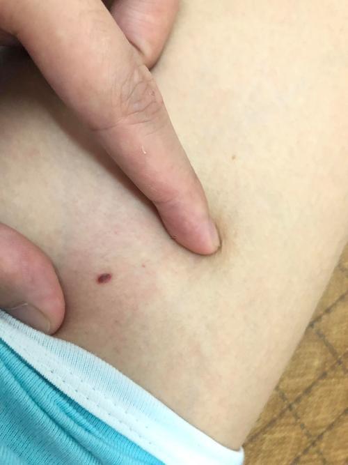 大腿上有痣