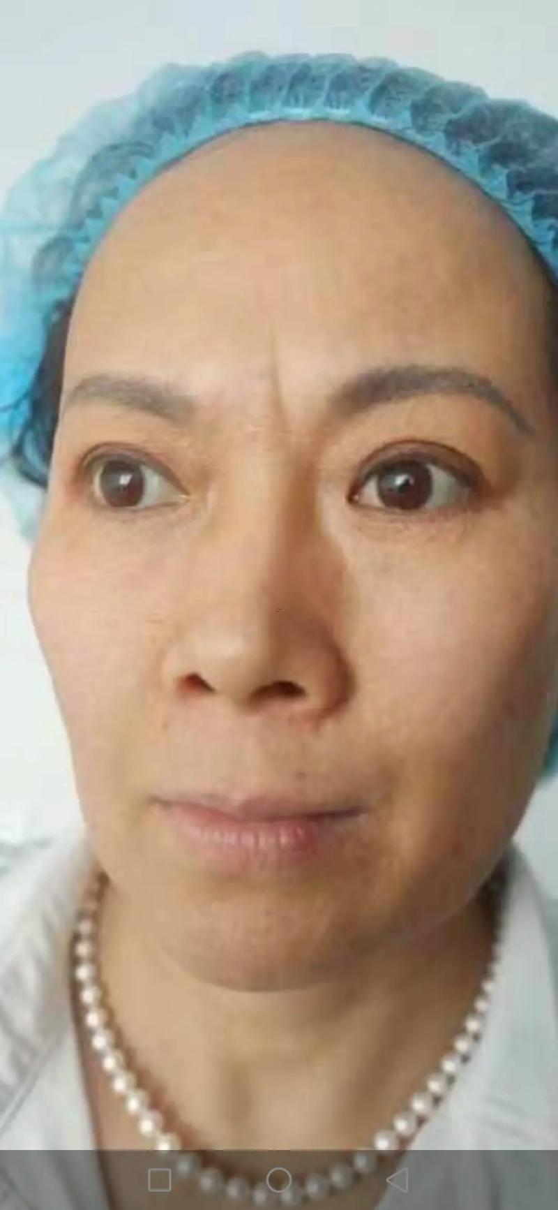 額頭豎紋