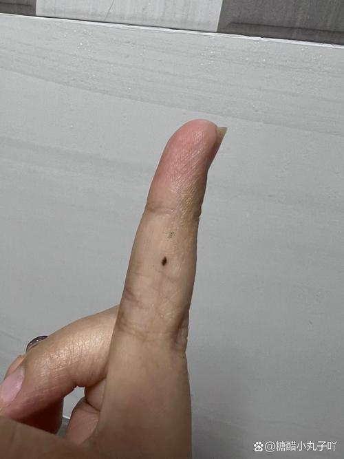 右手無名指有痣