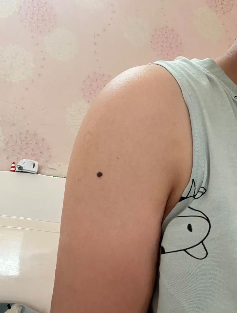 肩膀上有痣