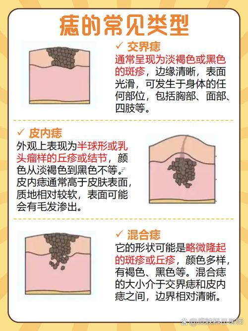 胸下有痣