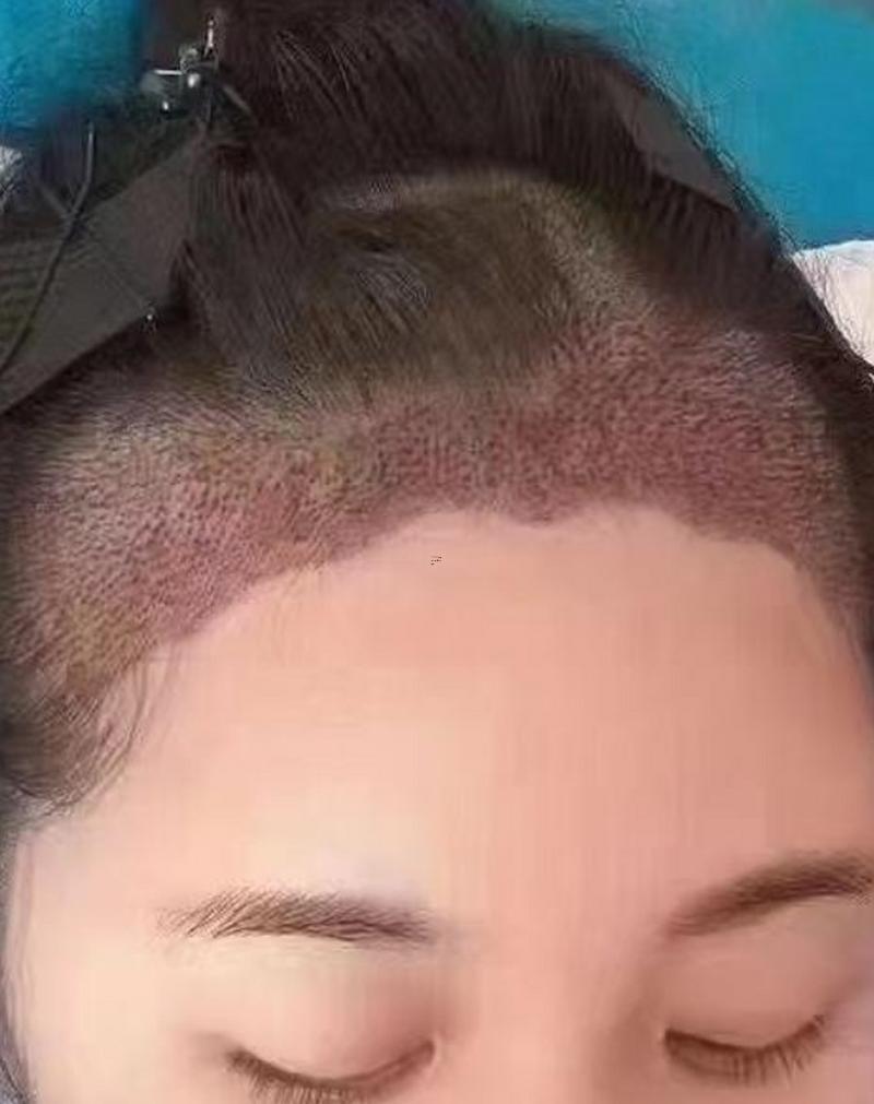 美人尖發(fā)際線