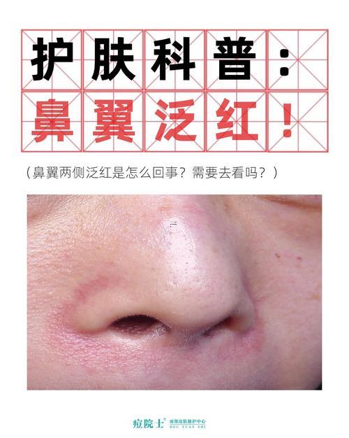 鼻尖發(fā)紅