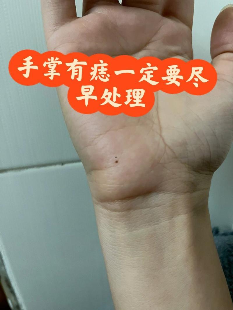手上長痣圖解