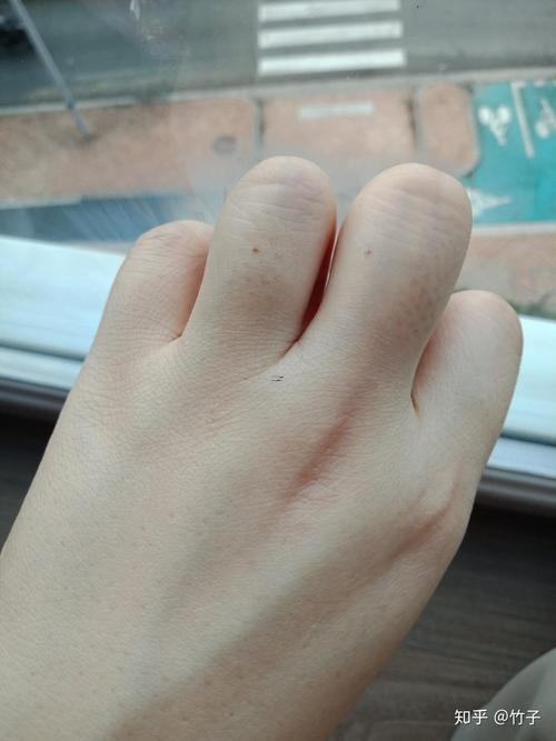 左手無(wú)名指有痣