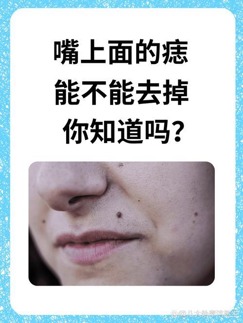 上嘴唇有痣