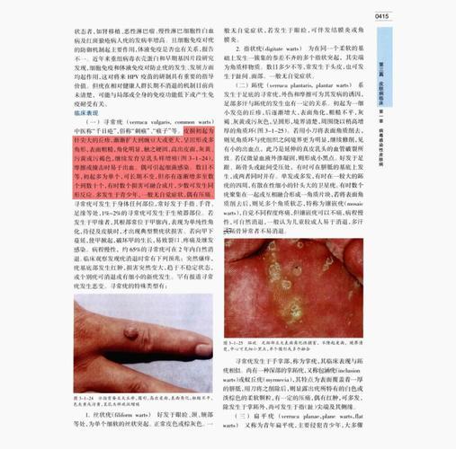 頭上長瘊子