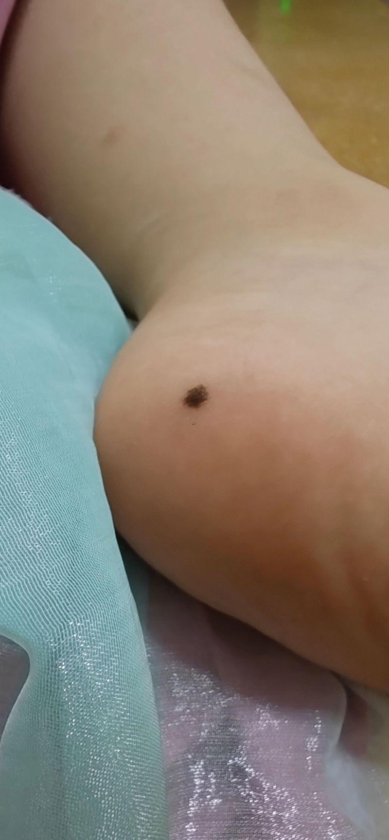 腿上有痣