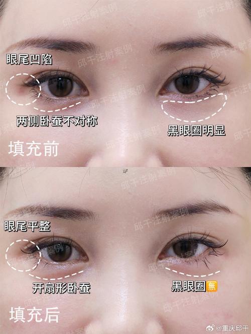 還行臥蠶不對(duì)稱面相