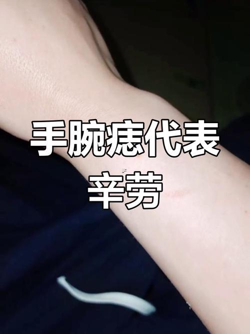 手腕長痣代表什么東西東西