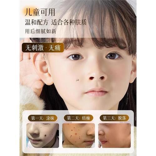 臉上長黑痣