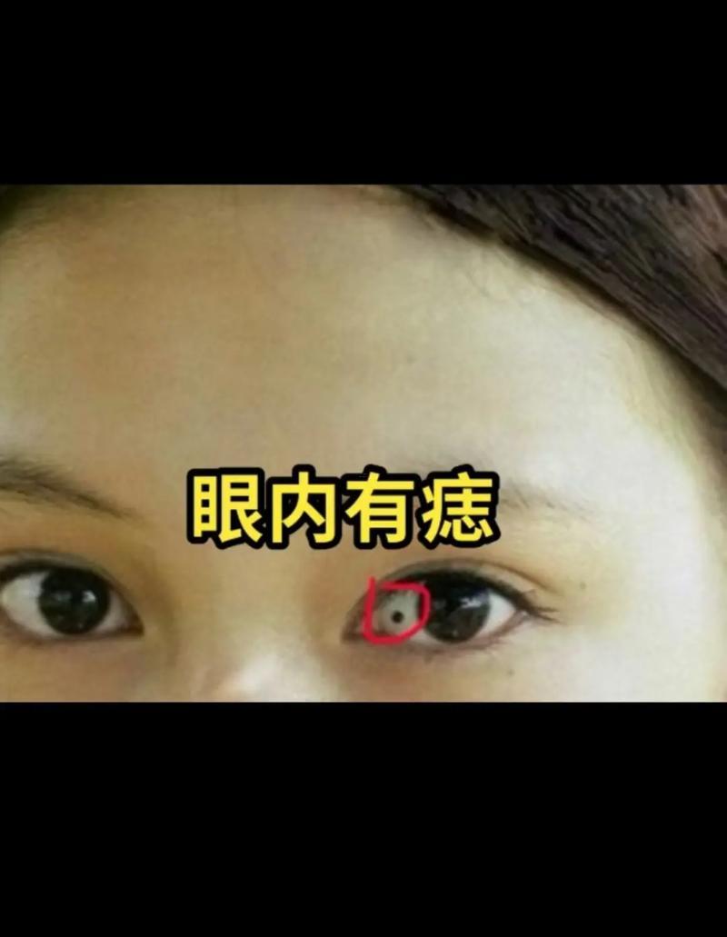 眼白有痣