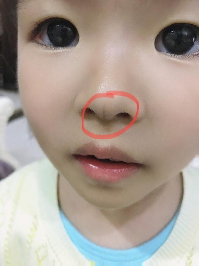 鼻子中間有顆痣