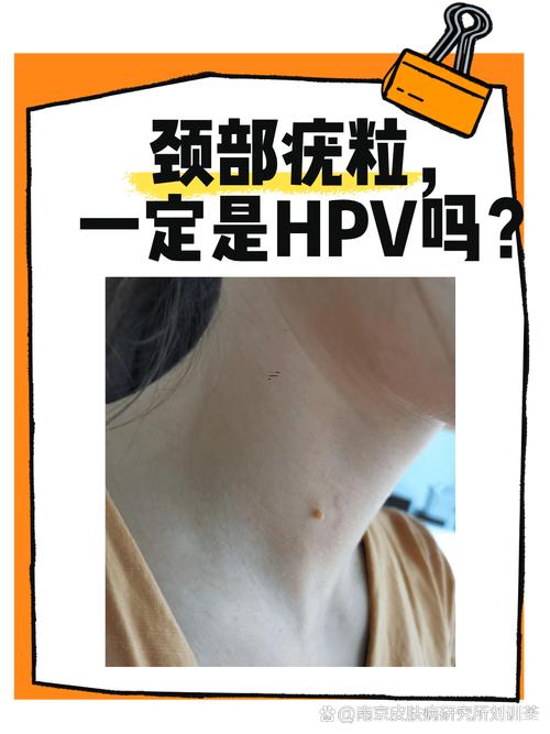 脖子上長(zhǎng)瘊子
