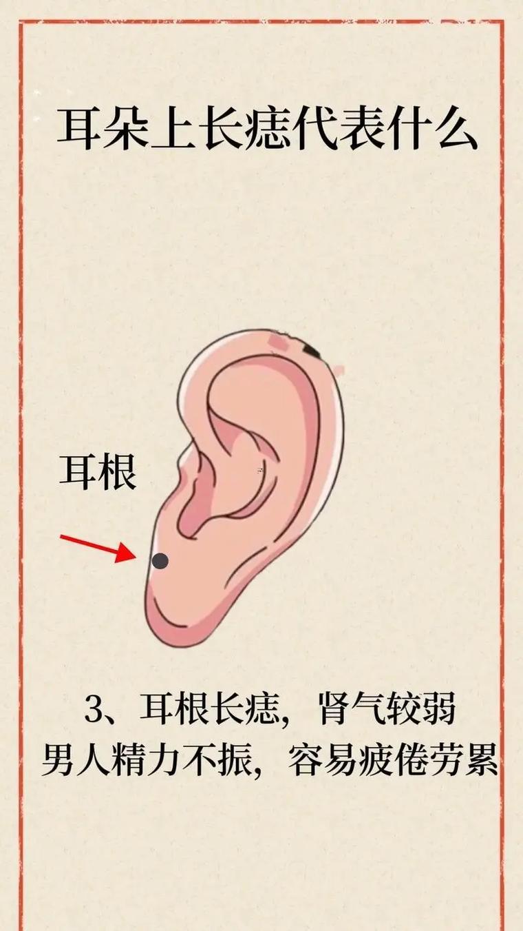 耳廓長痣