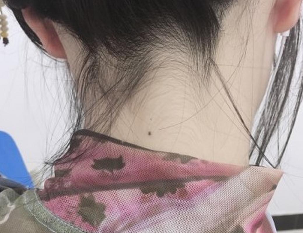 頭發(fā)里有痣