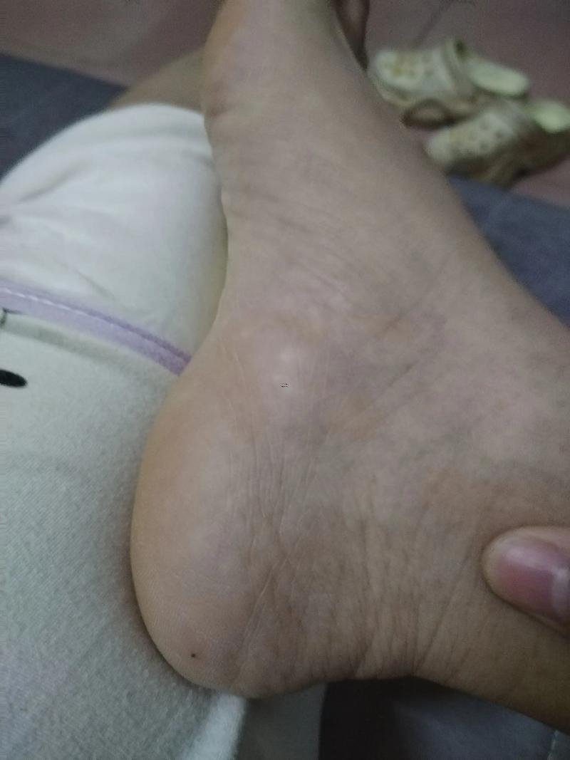 腳上痣圖解