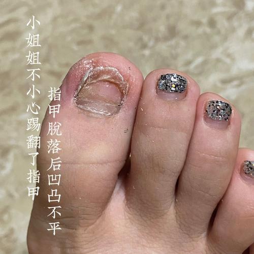 夢見腳趾甲掉了