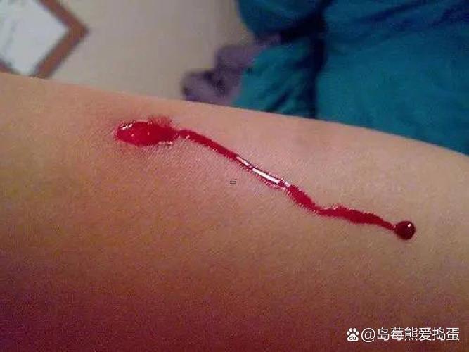 夢(mèng)見自己流血是何事預(yù)兆