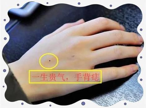 左手手背長(zhǎng)痣