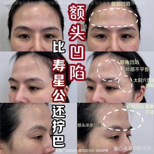 額頭骨頭凸起