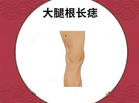 腿上長(zhǎng)痣代表啥