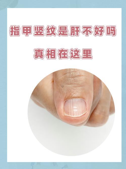 指甲蓋上有豎紋