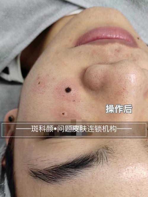 臉上黑痣
