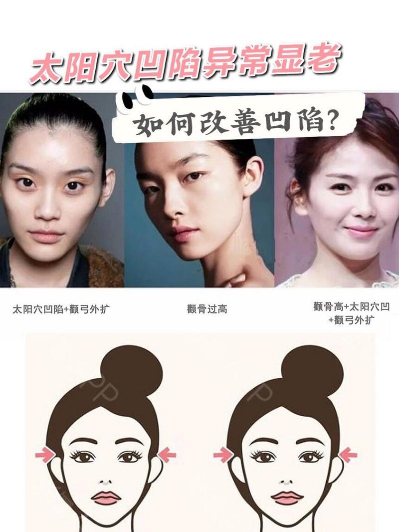 夫妻宮凹陷