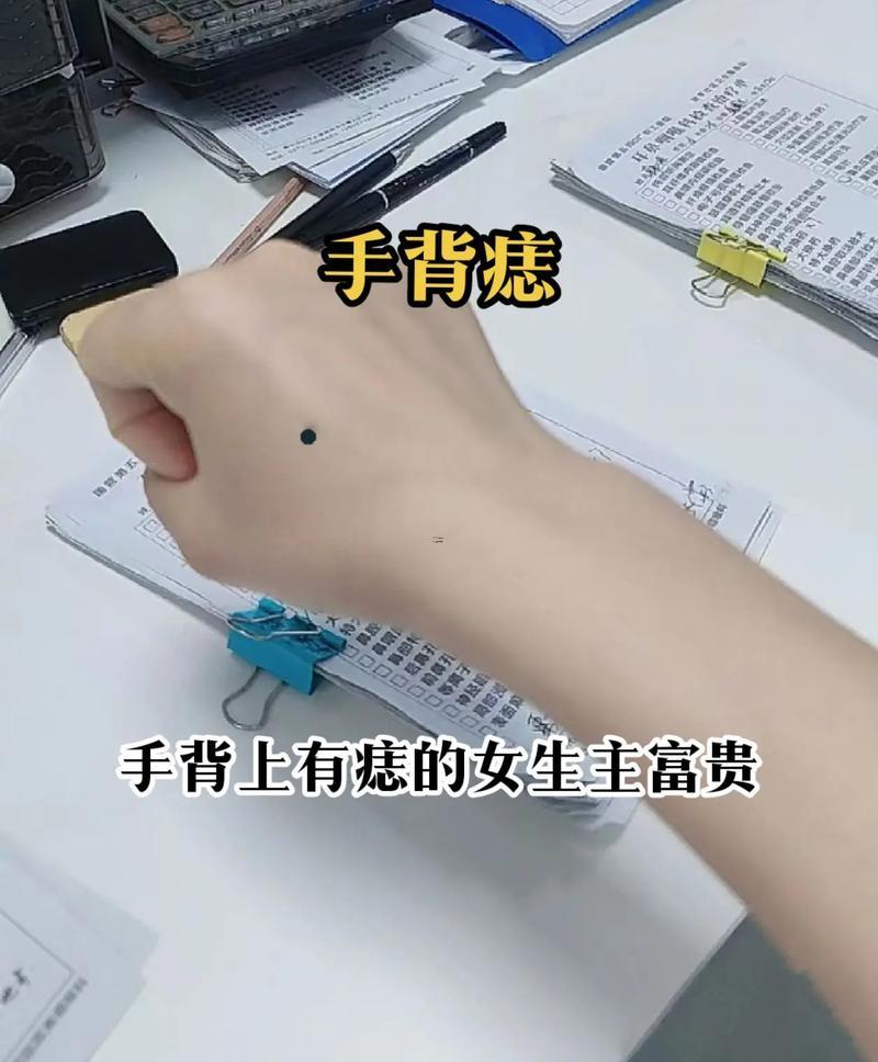 手背長痣代表什么