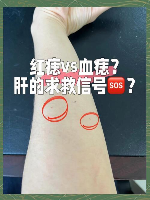 身上有紅痣