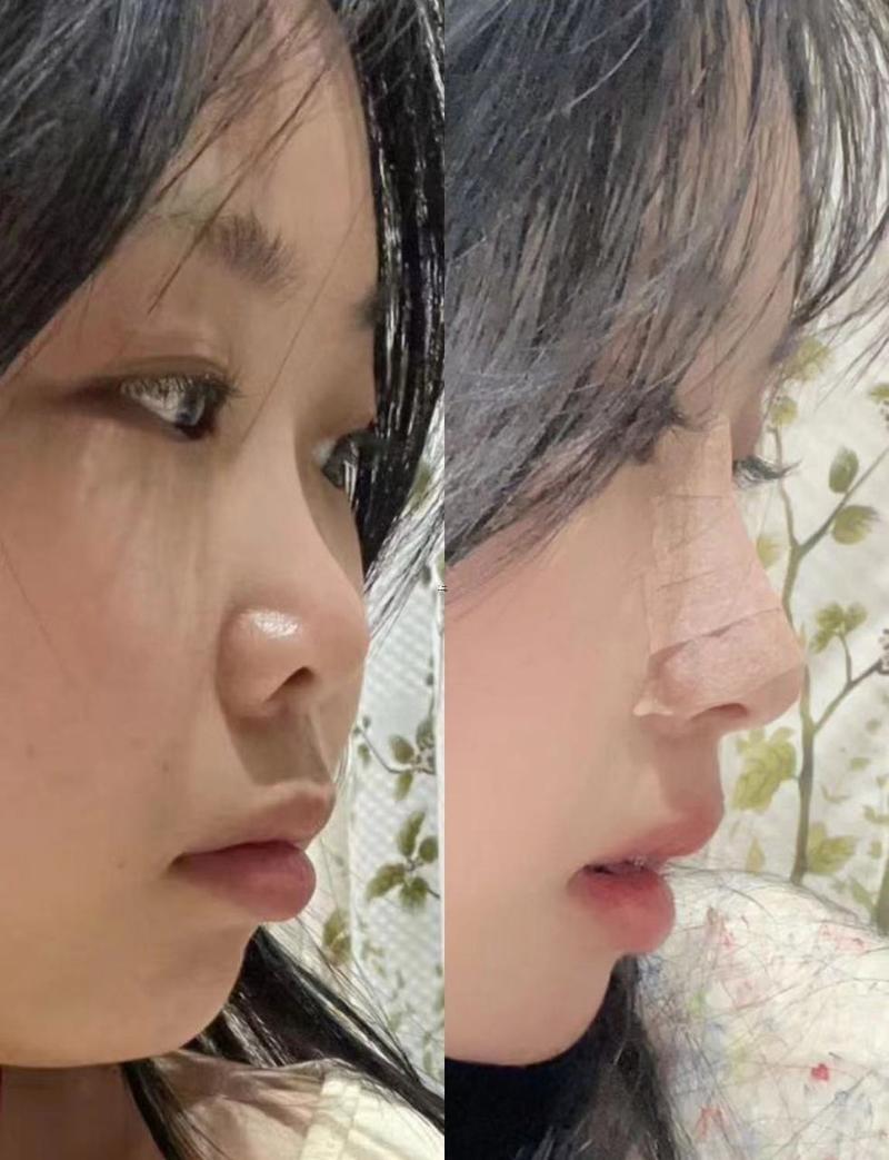 朝天鼻好不好