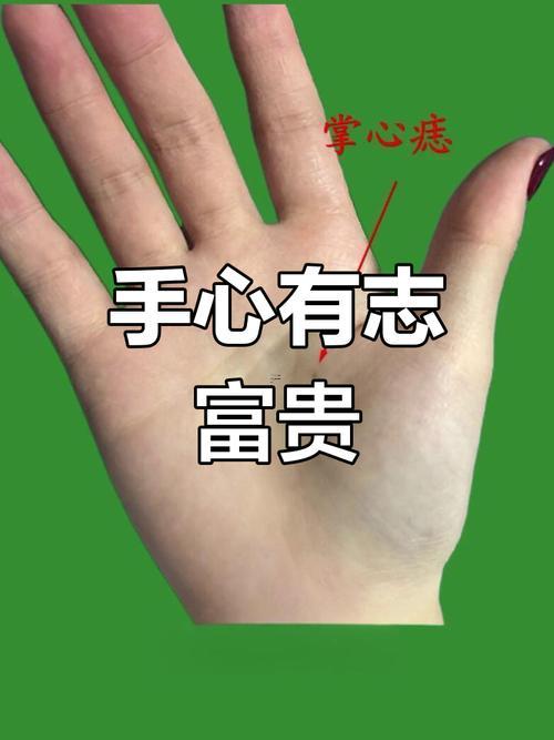掌心長痣
