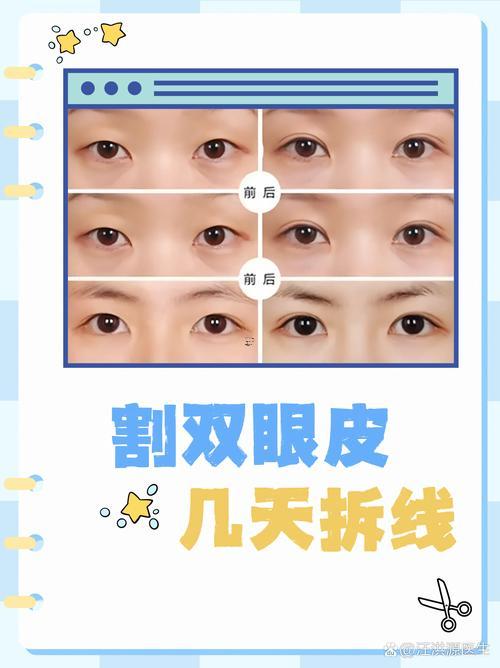 10月做雙眼皮吉日如何