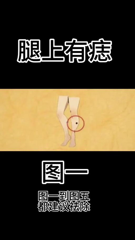 大腿長痣