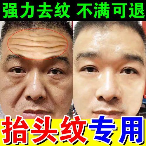 永久去除懸針紋
