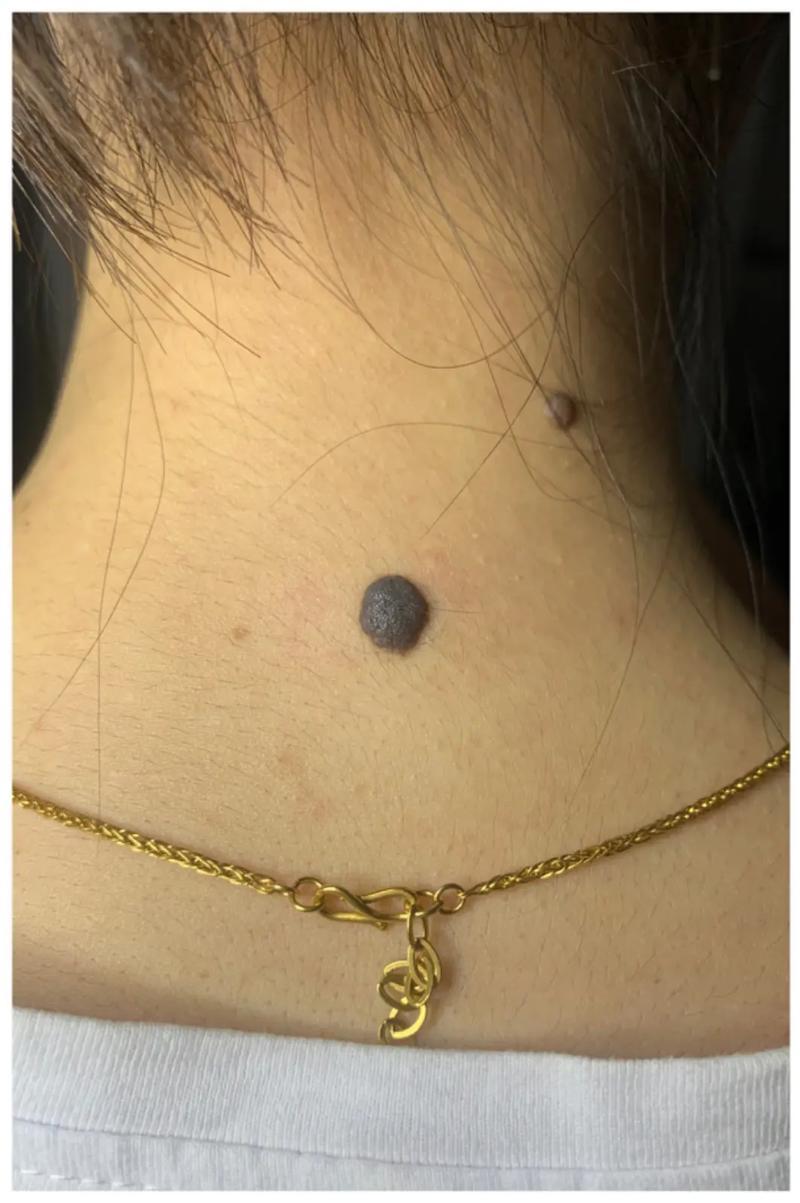 脖子上有痣代表什么東西