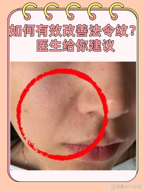 法令紋深怎么辦