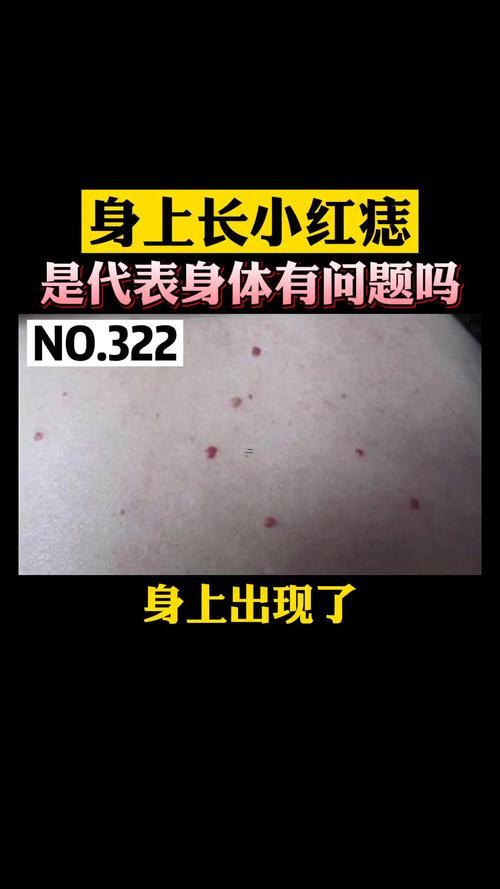 身上長紅痣