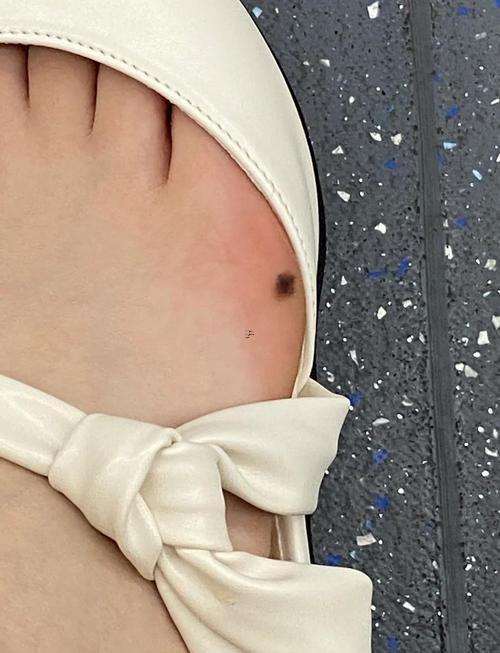 腳上長痣代表啥