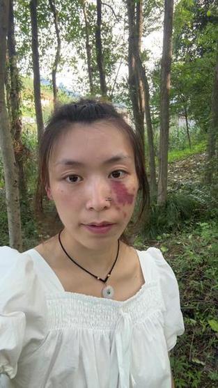 胎記的女孩