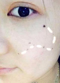北斗七星痣