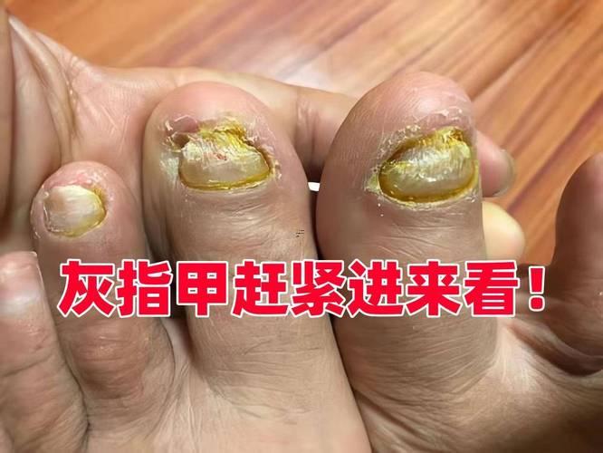 夢見指甲斷了